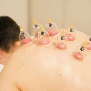 Cupping terapija
